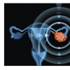 由玛丽女王大学研究人员领导的关于卵巢癌家族和遗传风险的新NICE指南现已发布
